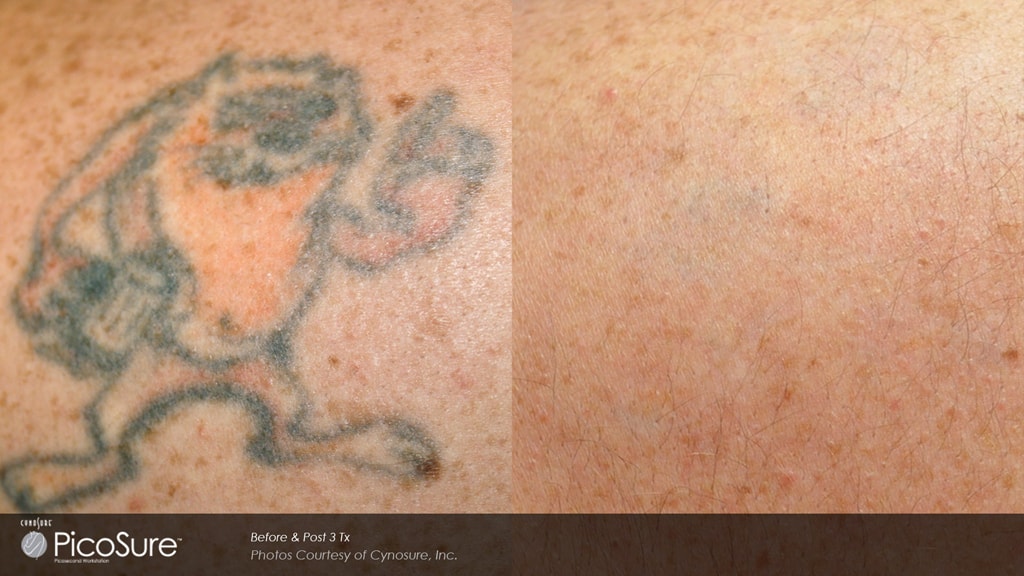Tattoo Removal Photos - Dr. Απόστολος Καραλέξης